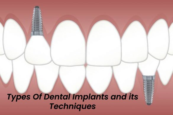 Types Of Dental Implants and its Techniques