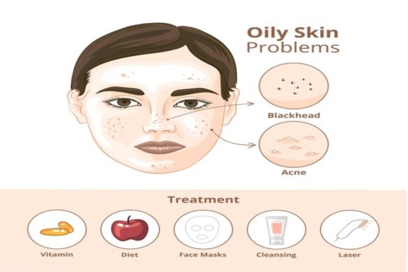 What Should I do? If I Have an Oily Skin