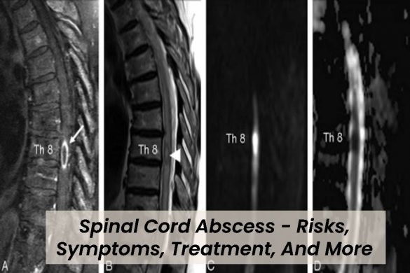 Spinal Cord Abscess - Risks, Symptoms, Treatment, And More