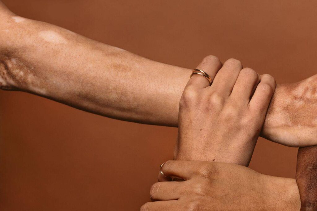 What is Vitiligo? Causes, Symptoms and Treatment