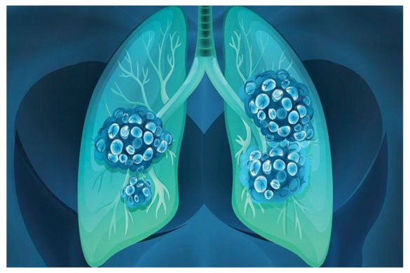 Lung Cancer