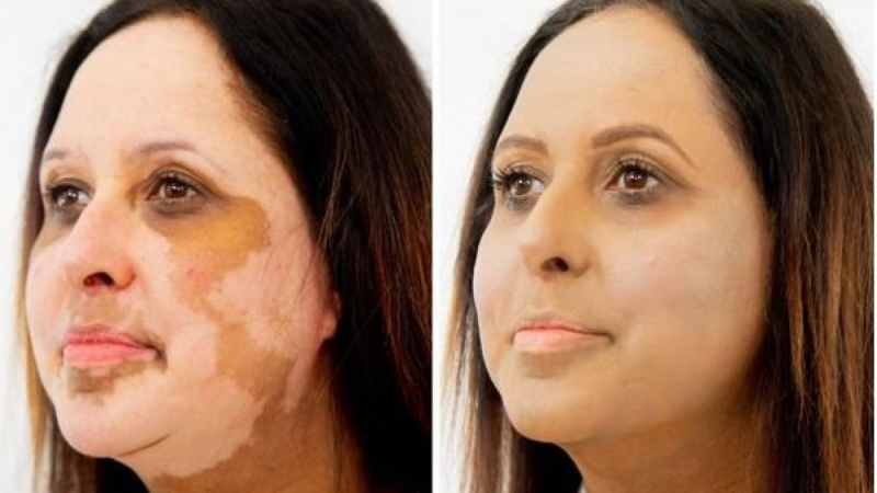 How is Vitiligo Treated?