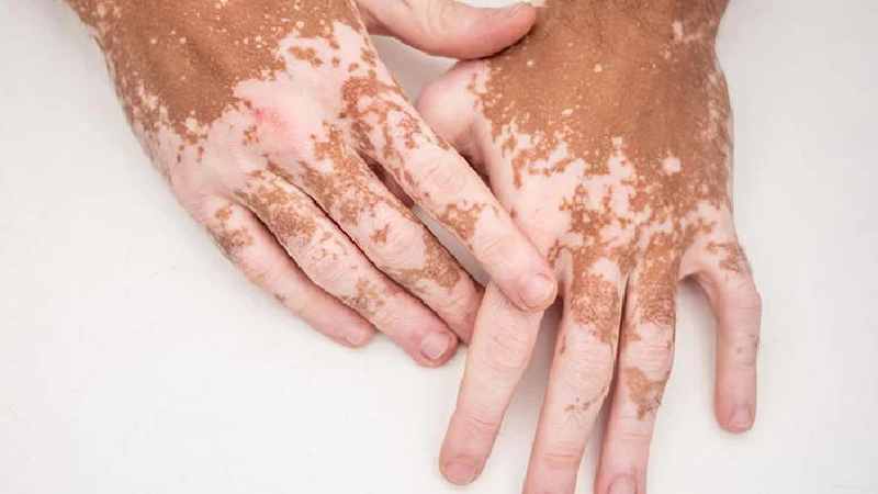How is vitiligo manifested? Vitiligo symptoms