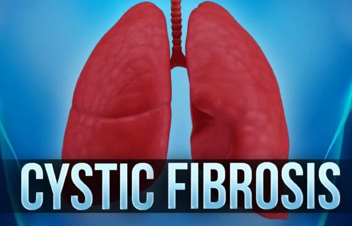 Cystic Fibrosis