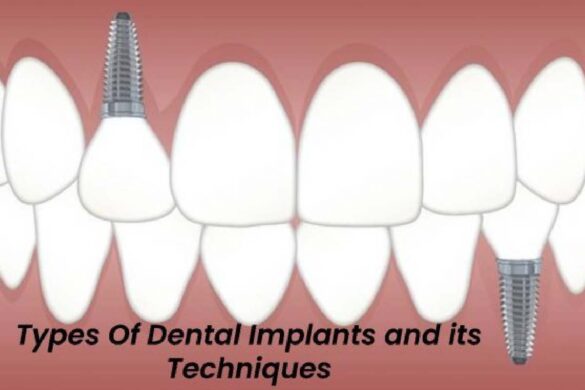 Types Of Dental Implants and its Techniques