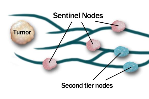 What is Sentinel Node Detection and its Harms