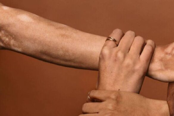 What is Vitiligo? Causes, Symptoms and Treatment