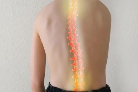 Scoliosis Unveiled Your Comprehensive Guide